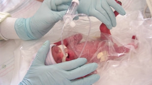 Prematüre bebeğe kalp ameliyatı başarılı oldu