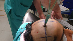 Abisinin attığı makas başına saplandı