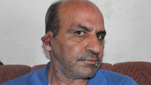 İranlı sığınmacı protesto için ağzını ve kulaklarını dikti