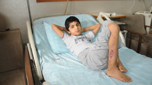 Kaza kurşunu ile dağılan çeneye bacak kemiğinden nakil