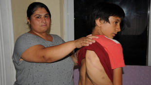 Omurga eğriliği olan genç kız yardım bekliyor