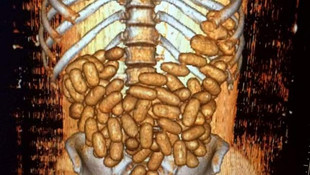 Nijerya uyruklu kaçakçının sindirim sisteminde 115 kapsül kokain bulundu