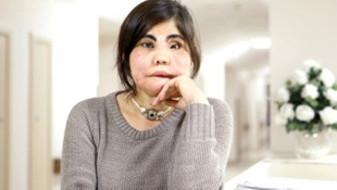 Türkiyenin yüz nakli yapılan ilk kadını öldü