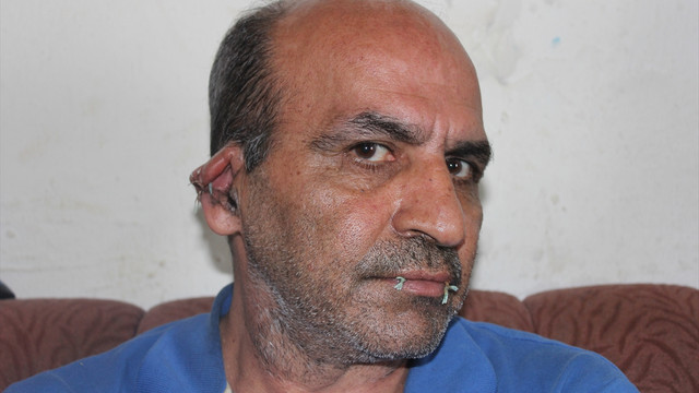 İranlı sığınmacı protesto için ağzını ve kulaklarını dikti