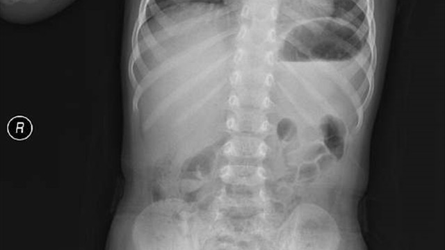 Yuttuğu pil yemek borusunu yaktı