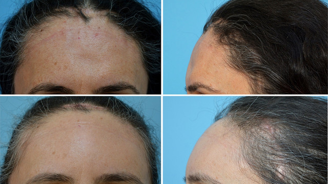 Kayseride 3D teknolojisiyle titanyumdan alın kemiği yapıldı