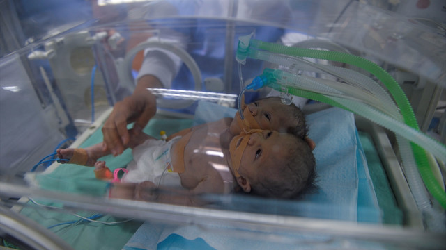 Gazze'de yapışık ikiz dünyaya geldi