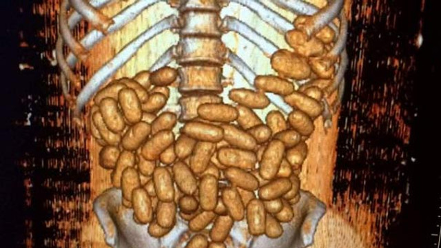 Nijerya uyruklu kaçakçının sindirim sisteminde 115 kapsül kokain bulundu