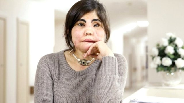 Türkiyenin yüz nakli yapılan ilk kadını öldü